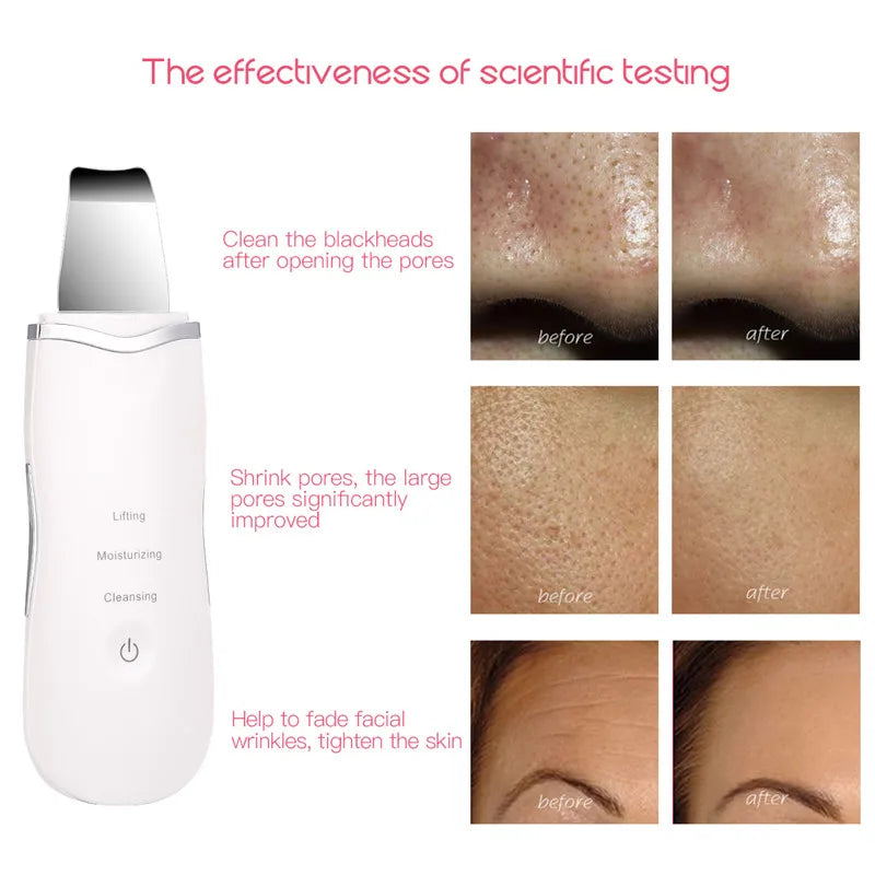 3-in-1 Ultrasonic Facial Skin Scrubber and Pore Cleaner