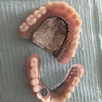 Suction-Retained Full Mouth Dentures for Seniors
