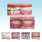 3-Stage Kids Dental Orthodontic Alignment Trainer Set