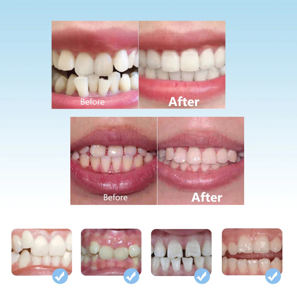 3-Stage Kids Dental Orthodontic Alignment Trainer Set