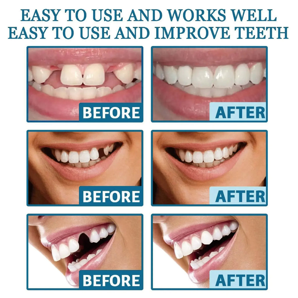 Adjustable Snap-On Dentures for Instant Smile Repair