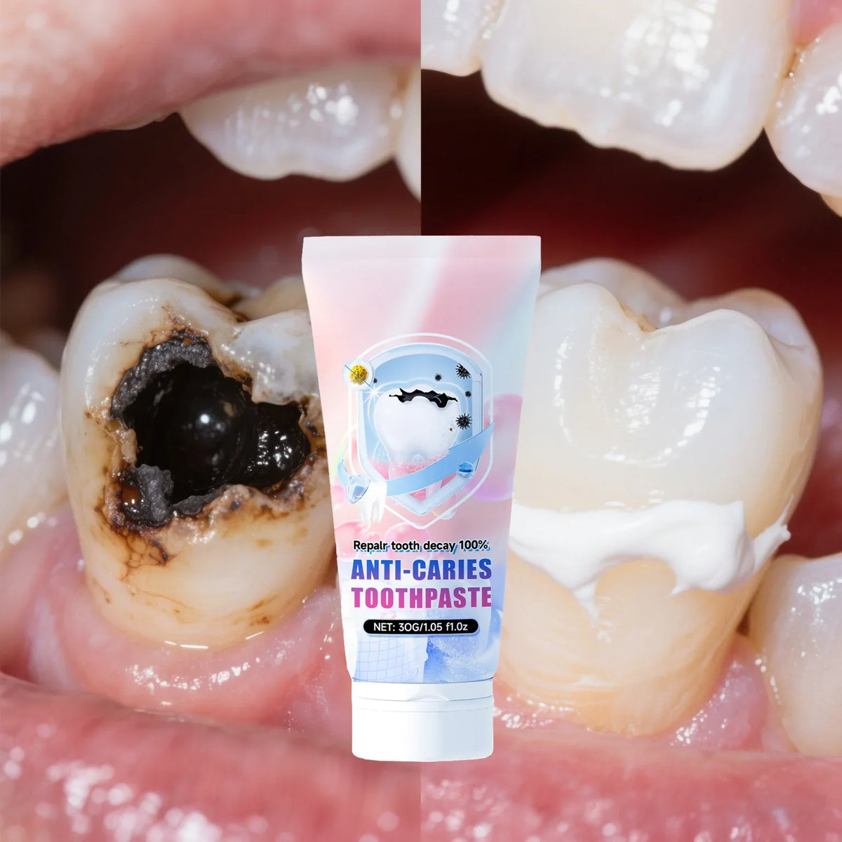 Anti-Caries Repair Toothpaste for Cavity Prevention