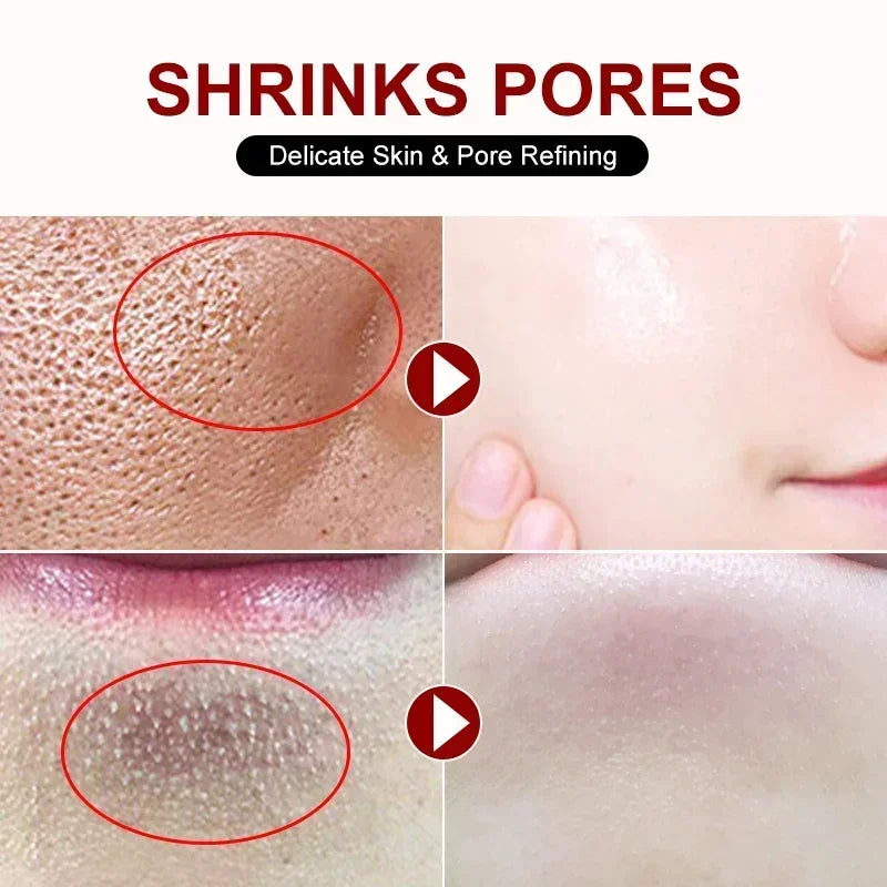 Salicylic Acid Pore Refining Cream for Acne and Blackheads