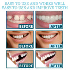 Instant Snap-On Temporary Dentures for Smile Correction