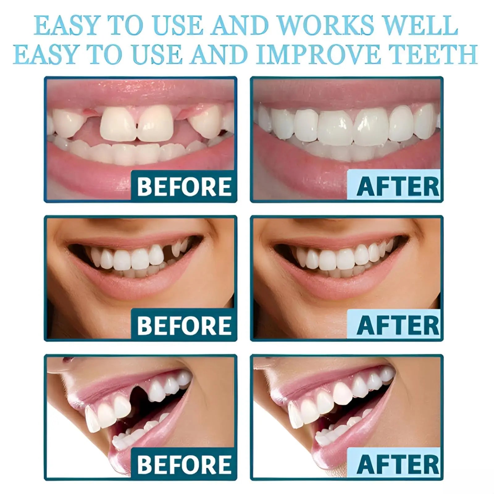Instant Snap-On Temporary Dentures for Smile Correction