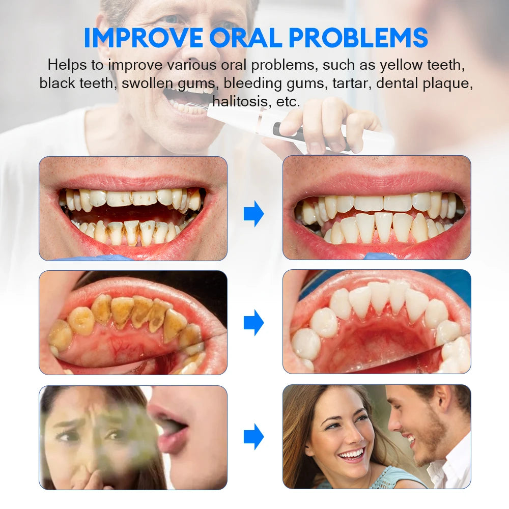 Ultrasonic Electric Teeth Cleaner and Tartar Remover