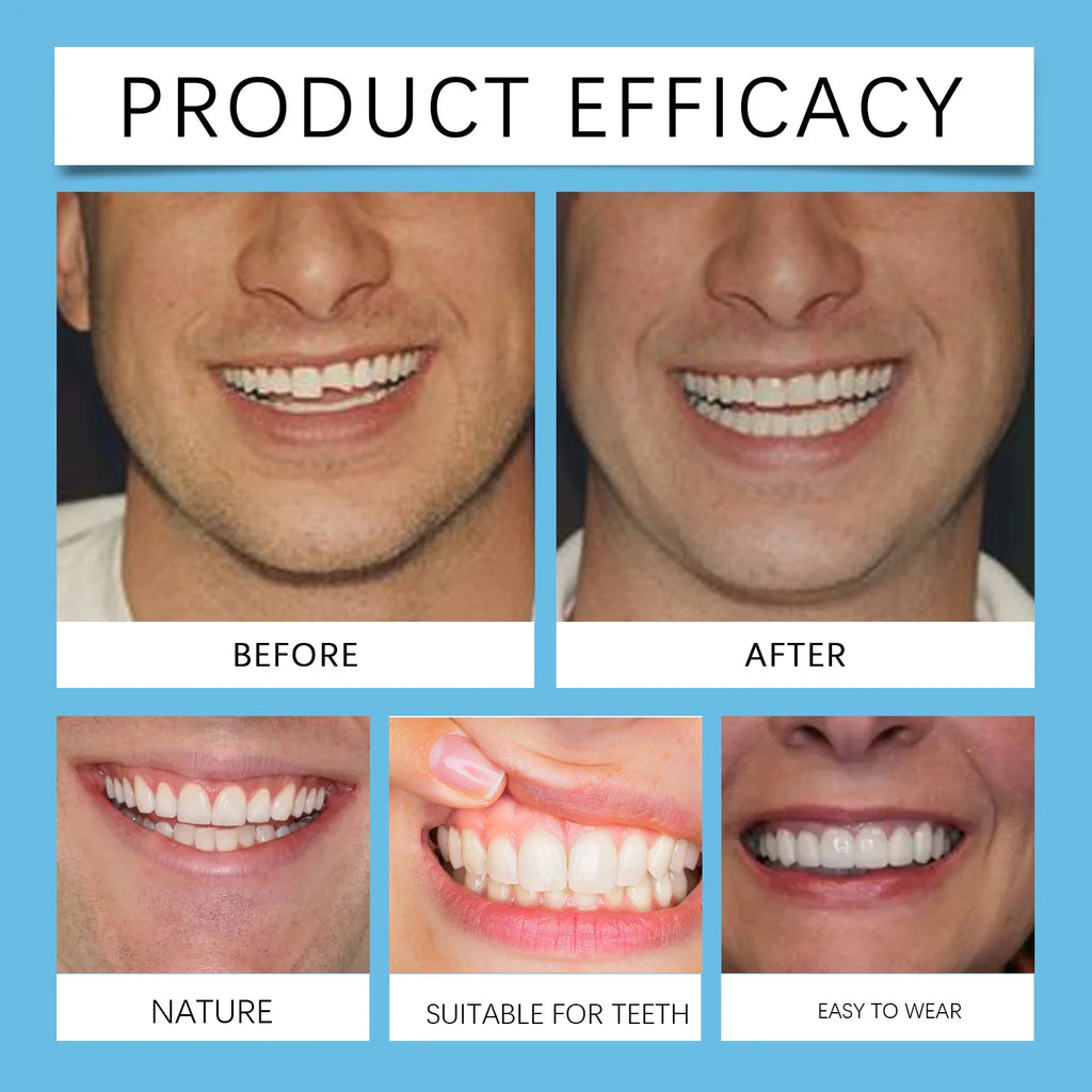 Temporary Silicone Snap-On Veneer Dentures Set