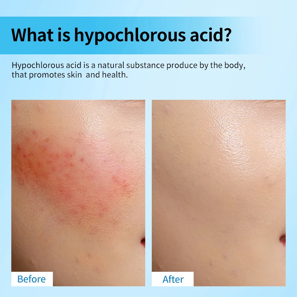 Hypochlorous Acid Facial Spray for Skin Redness and Acne
