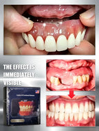 Suction-Retained Full Mouth Dentures for Seniors