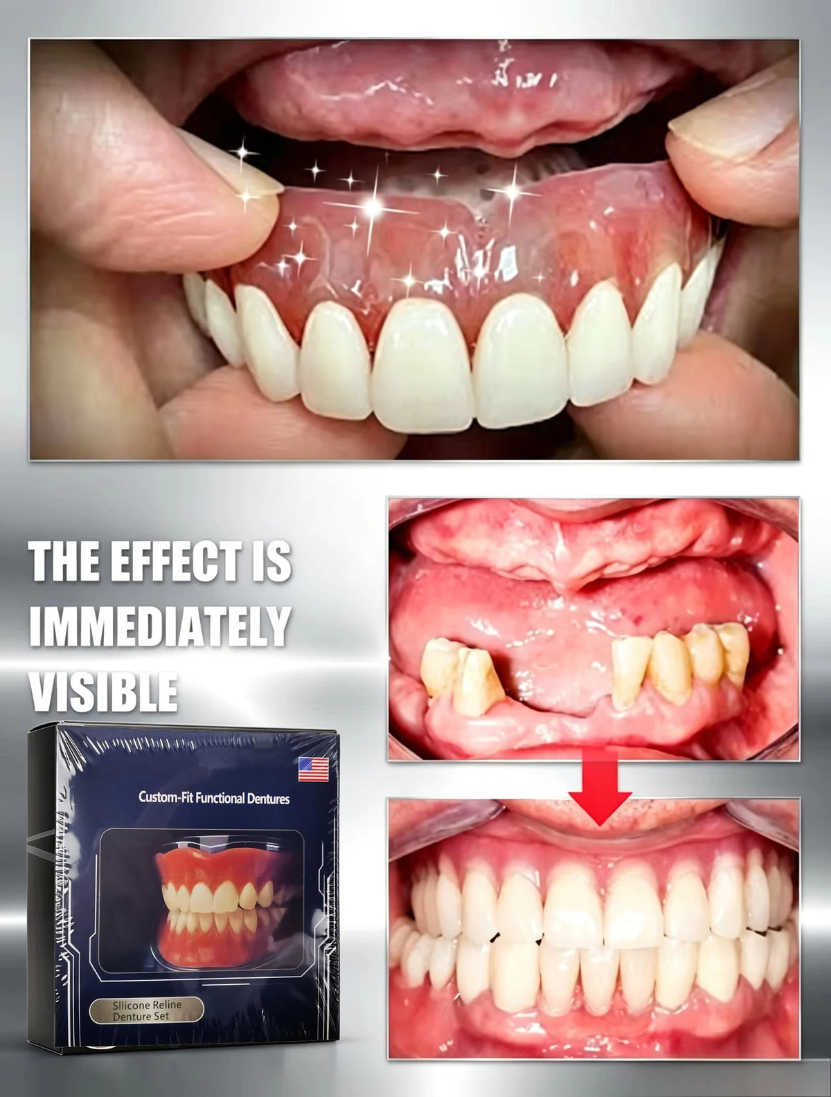 Suction-Retained Full Mouth Dentures for Seniors