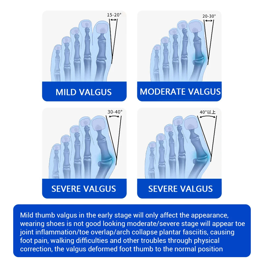 Adjustable Bunion Corrector and Big Toe Straightener - 14