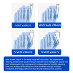 Adjustable Bunion Corrector and Big Toe Straightener