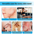 Hypochlorous Acid Facial Spray for Skin Redness and Acne