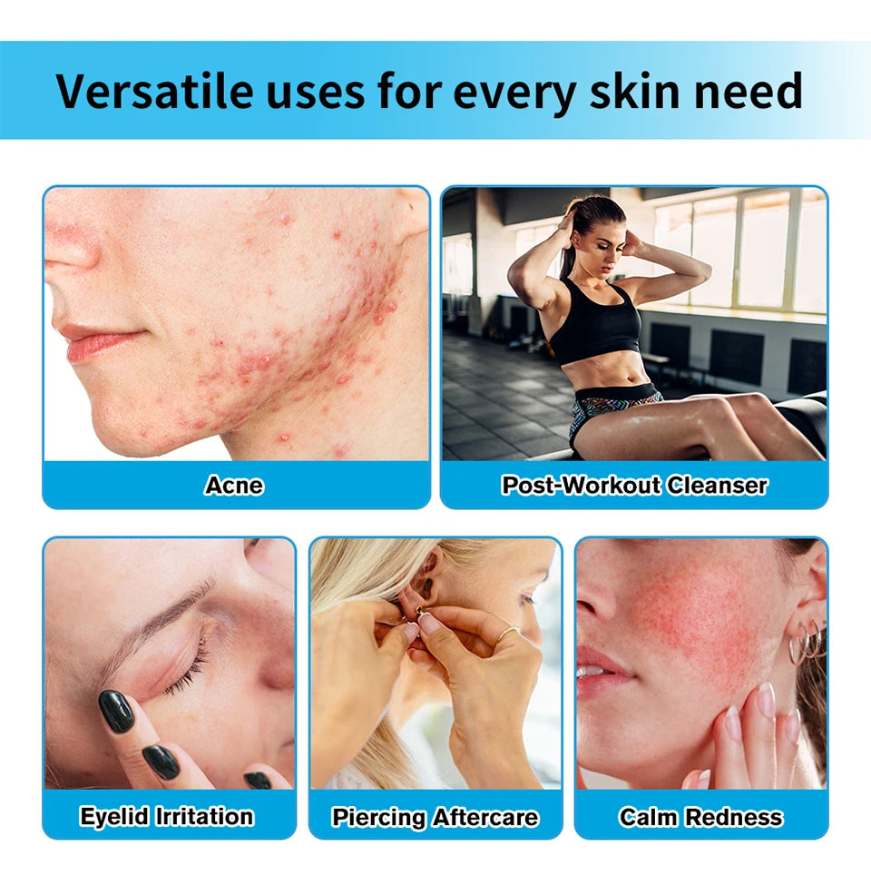 Hypochlorous Acid Facial Spray for Skin Redness and Acne