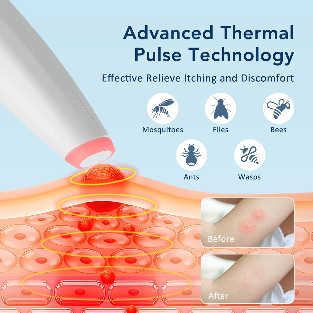 Electronic Itch Relief Pen for Insect Bites and Stings