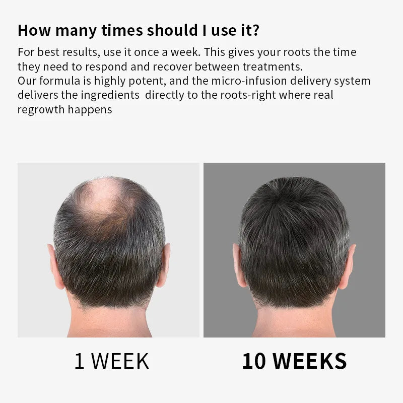 Microneedle Hair Regrowth and Scalp Nourishing Treatment Kit