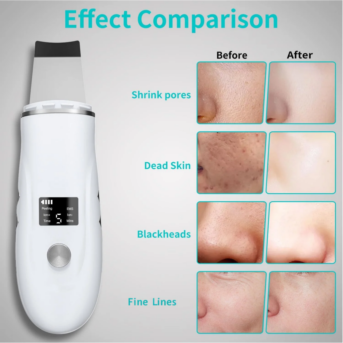 4-in-1 Ultrasonic Facial Skin Scrubber and Blackhead Remover