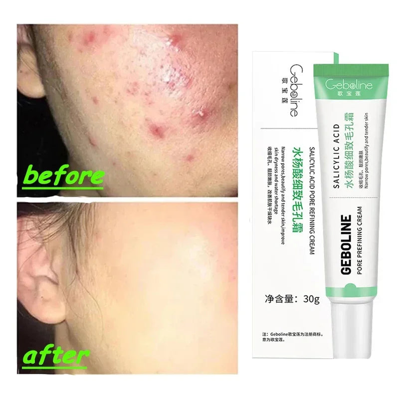 Salicylic Acid Pore Refining Cream for Acne and Blackheads
