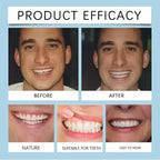 Instant Smile Cosmetic Dental Correction Plates
