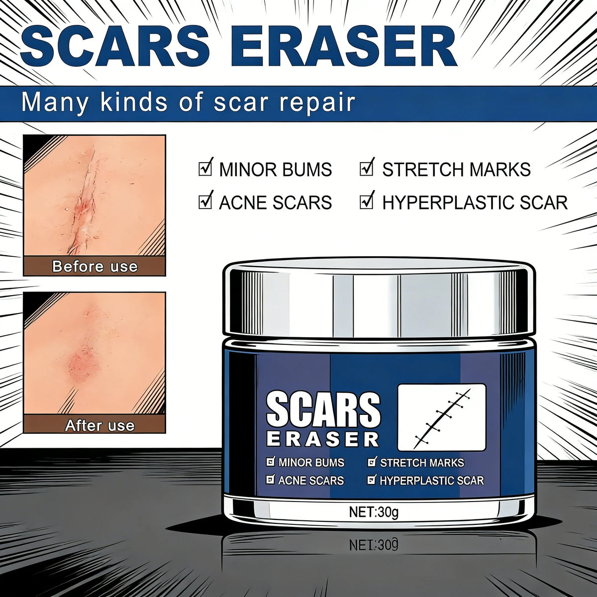 Scar Removal Cream for Acne Marks and Stretch Marks