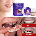 Comfortable Snap-On Cosmetic Dentures for a Natural Smile