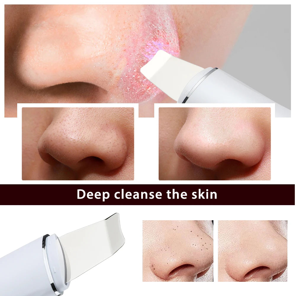 Ultrasonic Facial Skin Scrubber and Pore Cleaner - 6