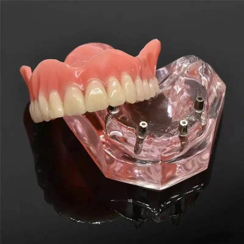 Full Arch Dental Implant Model for Patient Education and Practice