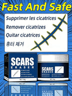 Scar Removal Cream for Acne Marks and Stretch Marks