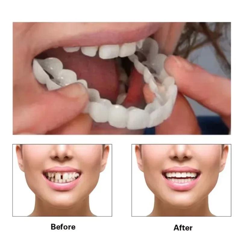 Snap-On Temporary Dental Veneers Kit for Instant Smile Whitening