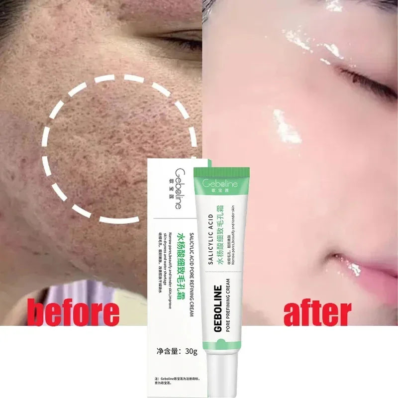 Salicylic Acid Pore Refining Cream for Acne and Blackheads