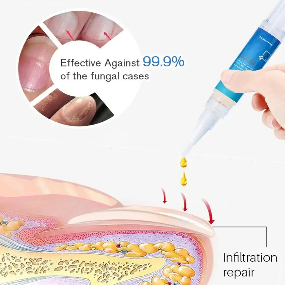 Laser Nail Fungus Treatment Device for Home Use - 2