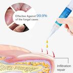 Laser Nail Fungus Treatment Device for Home Use