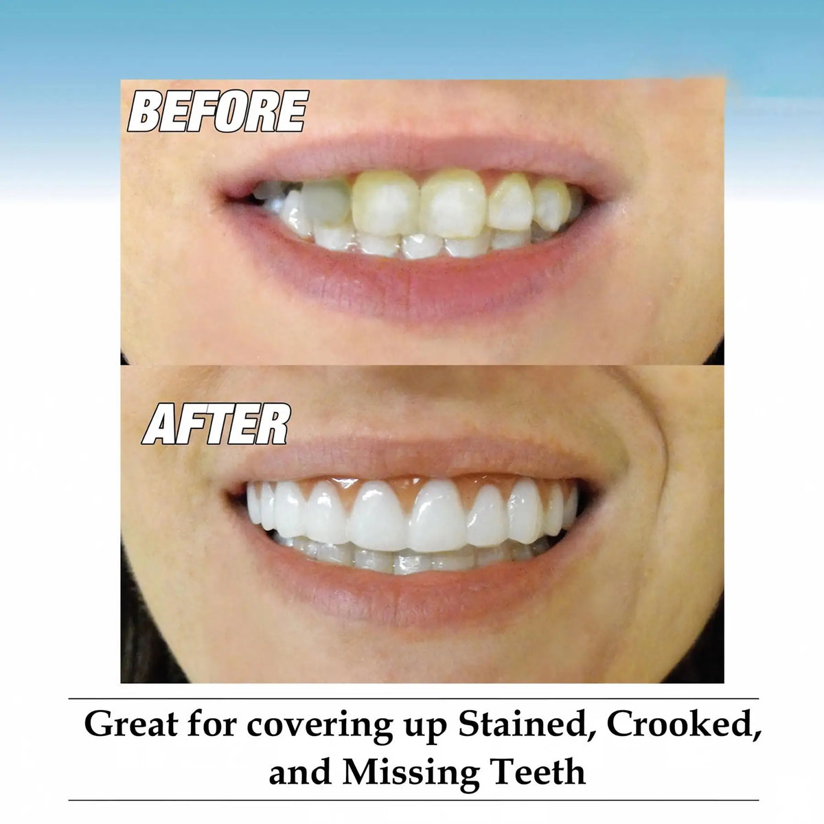 Moldable Silicone Denture Set for Instant Natural Smile