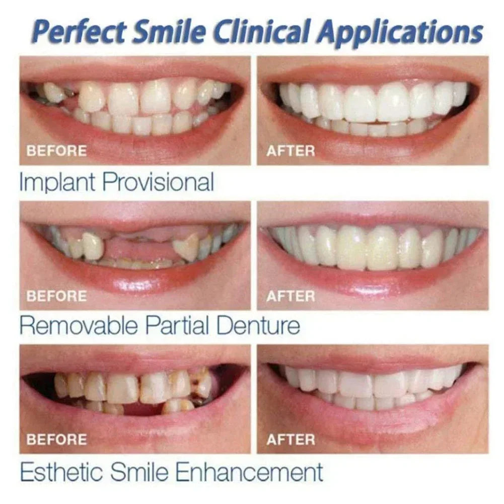 Snap-On Temporary Dental Veneers Kit for Instant Smile Whitening
