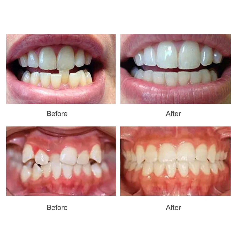 3-Stage Adult Orthodontic Teeth Trainer Alignment Mouthpiece