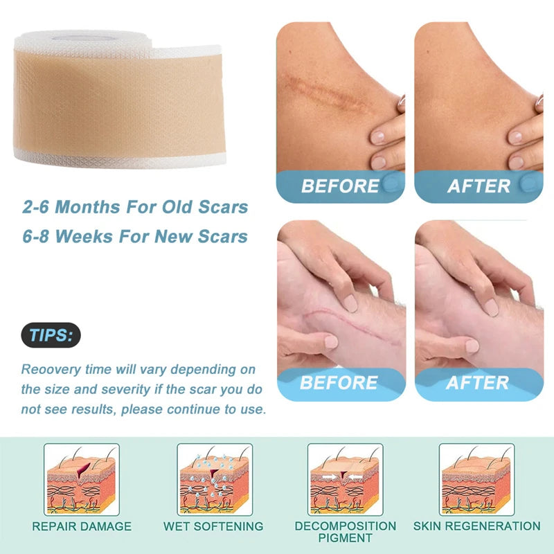 Reusable Silicone Gel Scar Removal Tape Roll